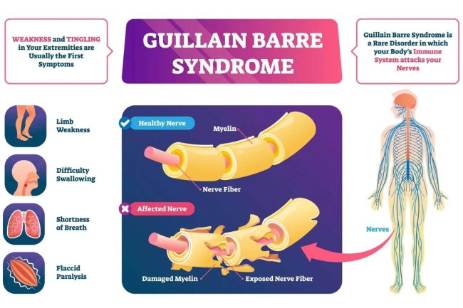 Understanding Guillain Barre Syndrome
