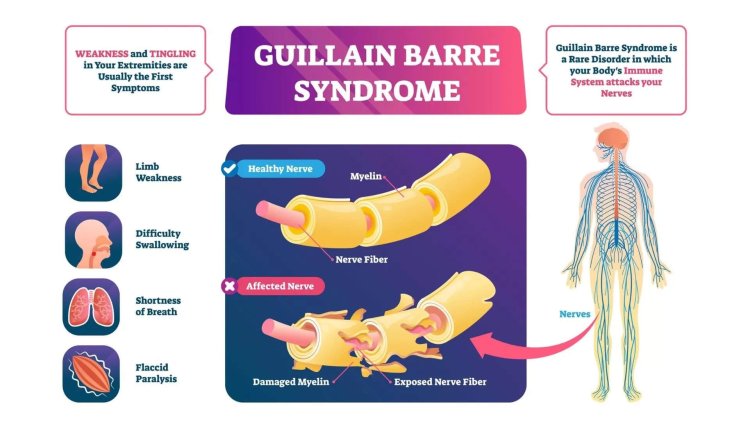 Understanding Guillain Barre Syndrome