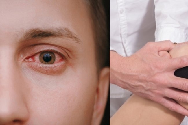 Increased Joint Pain and Arthritis Cases After Pink Eye in Delhi