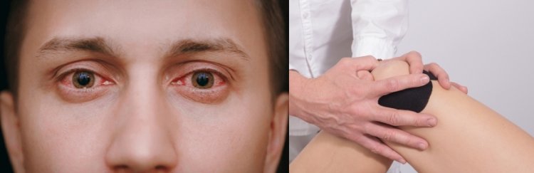 Increased Joint Pain and Arthritis Cases After Pink Eye in Delhi